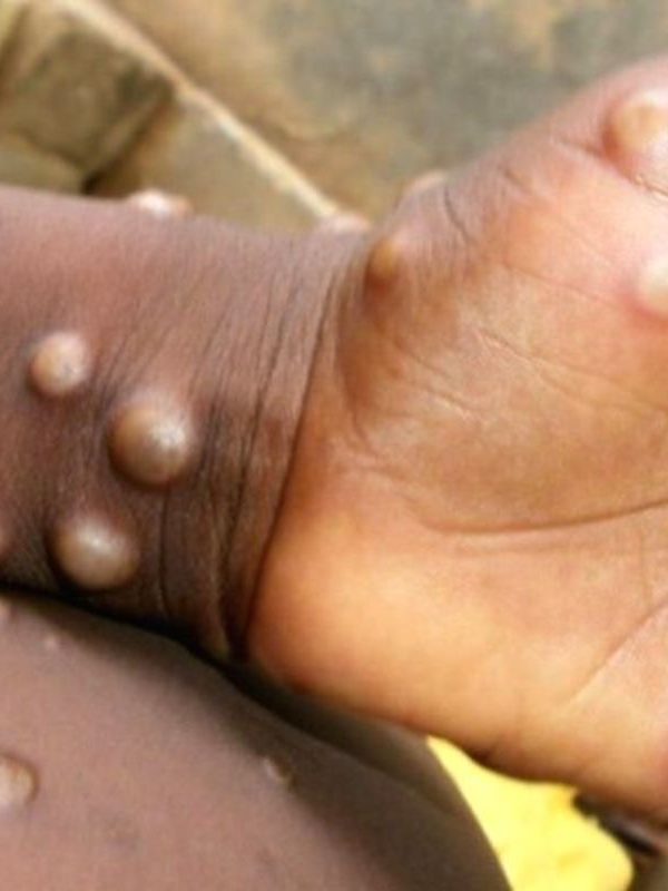 Mpox: L’OMS et les CDC Afrique lancent un plan de réponse conjoint