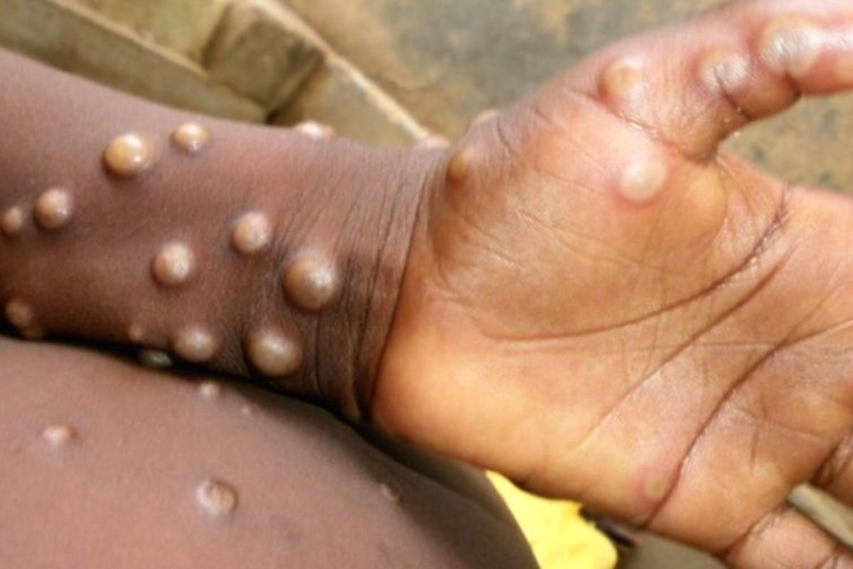 Mpox: L'OMS et les CDC Afrique lancent un plan de réponse conjoint 1